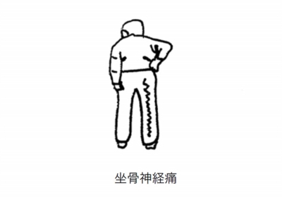 坐骨神経痛